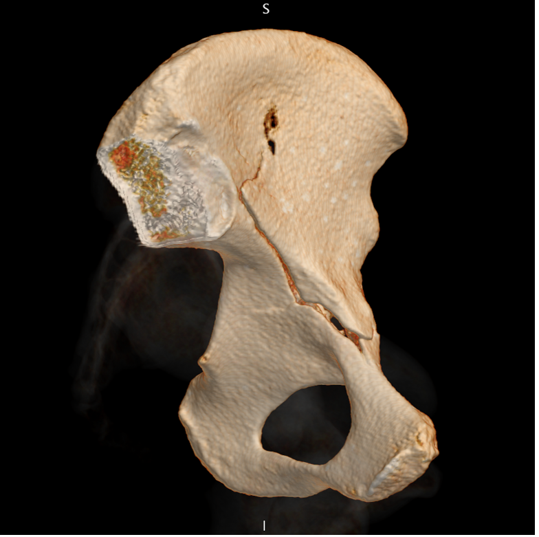 Anterior column fracture of the acetabulum on 3D CT. 
Classification of acetabular fractures so much easier on  3D CT.
#FOAMed