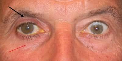 Ph_S_afwa_n's tweet photo. لو عندنا مريض مصاب بارتفاع في ضغط العين (Glaucoma) .. لكنه مصاب في عين واحدة فقط 👁 

هل يمكن استعمال قطرات (Bimatoprost) العينية ؟؟ 

📚 الجواب: 

هذا الدواء هو من أدوية (Prostaglandin Analogs) التي من آثارها الجانبية المعروفة: 

1️⃣ تغيير لون الجزء الملون من العين (القزحية Iris) .. 

2️⃣ زيادة نمو رموش العين و تثخينها .. 

لذلك 👇👇👇

إذا كان المريض مصابا ب(glaucoma) في عين واحدة فقط .. يفضل أن نستعمل دواء من غير هذه العائلة .. حتى لا تصبح العينان مختلفتين عند المريض 😅

مثلا نستعمل قطرات (Timolol) ..

🌟🌟 ملاحظة 🌟🌟

يمكن استعمال دواء (Bimatoprost) بتراكيز عالية لعلاج "قلة نمو الرموش" الذي يسمى: 

Hypo-trichosis of the Eyelashes

لكن تتوقعوا أن القطرة ستوضع داخل العين .. أو على الرموش من خارج العين ؟ 😁

💠 Reference: Rx prep for NAPLEX & others.

🌹Thank you 🌹 

#منقول
من صفحة الدكتور 
#د_وليد_السباخي 
#Pharmacology
#Ph_S_afwa_n 

🌼يمكنكم  متابعة جديد الدكتور عبر حساباته الرسمية في مواقع التواصل الإجتماعي التالية:🌼

💊 Official Telegram Channel:
https://t.co/eJb3oqQmWC

💊Official Facebook Page: 
https://t.co/eRSykpenV9

💊 Official Youtube Channel:
https://t.co/jLv4ikdtIf

#د_وليد_السباخي