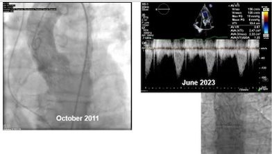 CoreValve 29mm implanted October 2011…still going strong after 12 years…mean gradient 6mmhg and trace PVL in June 2023…
The future is promising
@AtlanticHealth @Medtronic @Edwards_TAVR @TAVRBot @djc795 @LindaGillamMD @CardiacConsult @GilbertTangMD @MGKatz036 @PhilGenereuxMD