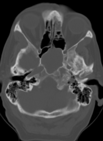 DrScottFortune's tweet photo. PCP calls you up and says: "Hey, I've got a patient with headaches, and I got this scan." What's your diagnosis and treatment plan? #rhinology #SinusCTscan #imaging #RhinologyClinic #Igotsinus #radiology #SinusRadiology https://t.co/BvSUp3g36I