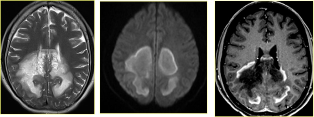 47 year female; classical one