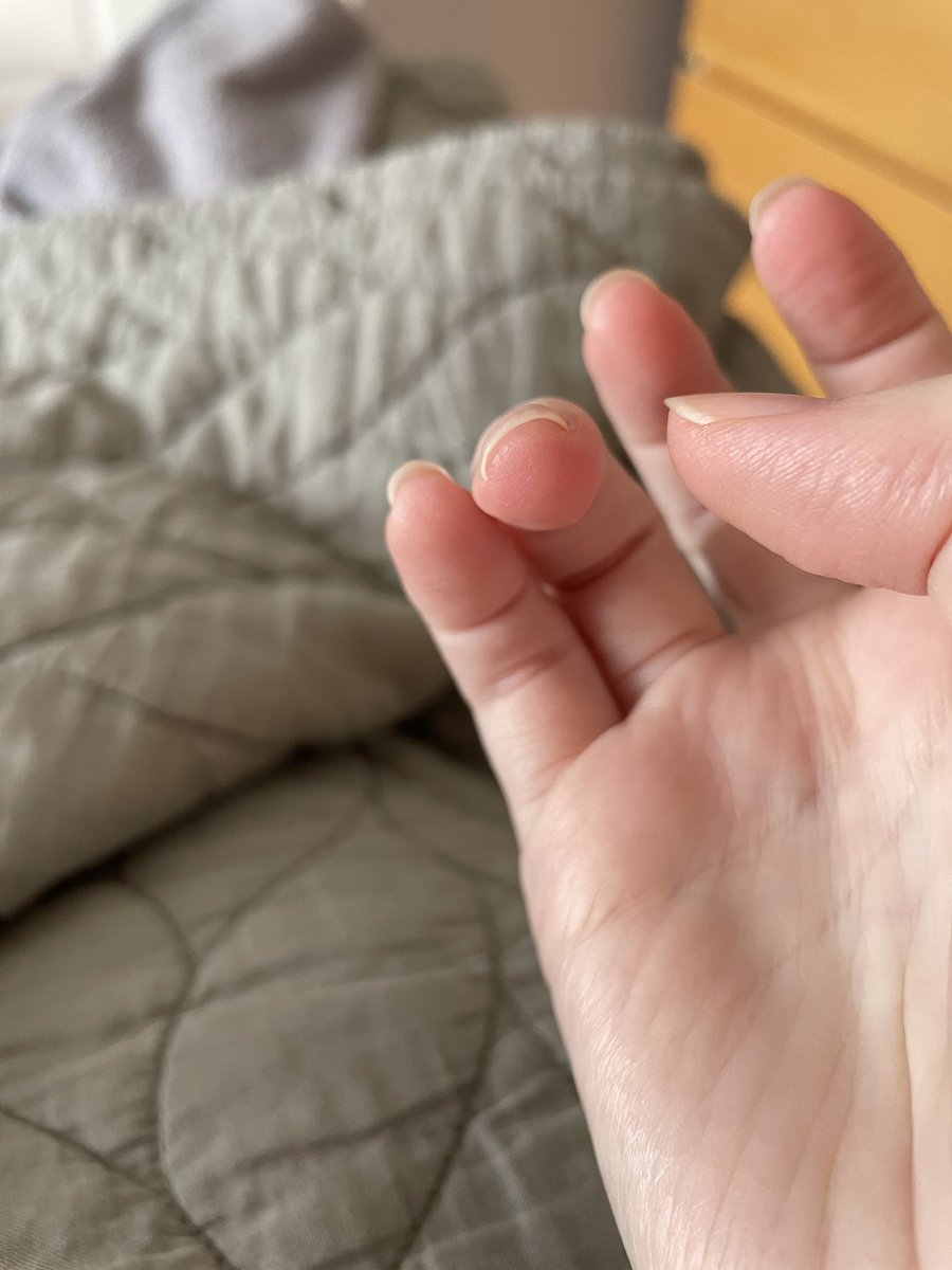 Random Q but maybe there’s #cancer patients on here who know: I developed not only “chemo curls” but pretty severe nail curling after #Rituximab last year. My nails are digging into and deforming my fingers + big toes, and it’s quite painful. Anyone know if this will stop w/time?