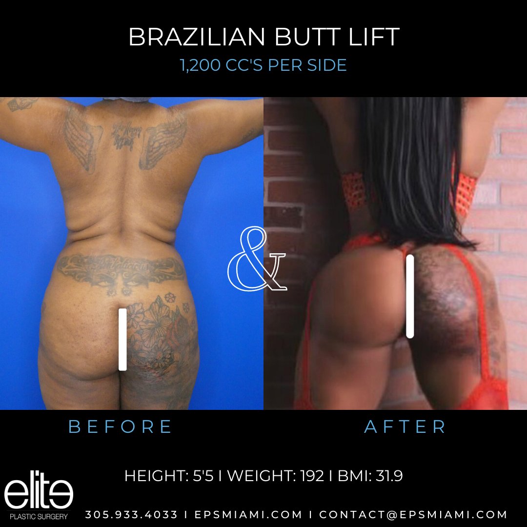 Beautiful curves and projection on this Elite Queen Her #brazilianbuttlift by Dr. Salama is perfection! Don’t wait for your transformation, contact us today!
💻 epsmiami.com
📞 305.933.4033
📧 contact@epsmiami.com
#BBL #buttaugmentation #bodysculpting #bodycontouring