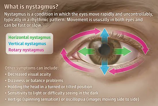@OGdukeneurosurg Nystagmus is a  rapid involuntary movement of the eyes.  forms of nystagmus: pathological and physiological.causes congenital disorder or sleep deprivation, acquired or central nervous system disorders, toxicity, pharmaceutical drugs, alcohol, or rotational movement.