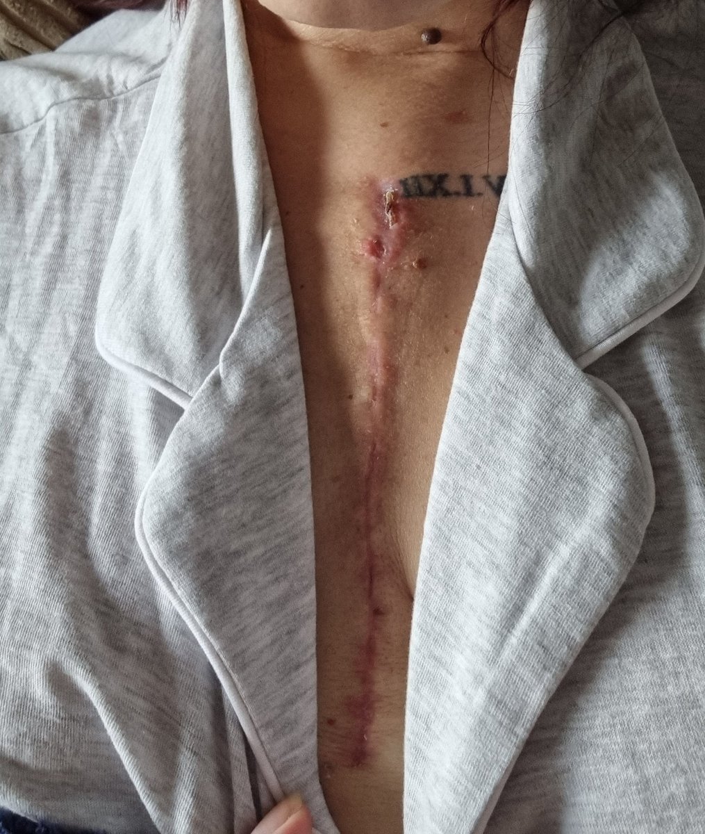 Jade1990STN's tweet photo. 37 weeks since my emergency open heart surgery and having to take a year out from uni, hated my scar at first but now I'm starting to embrace it, its apart of me and my story and in 12 weeks i can finally start back to uni and finish my nursing👩🏽‍⚕🫀 forever grateful #nhs https://t.co/i5WJ8dO3fS