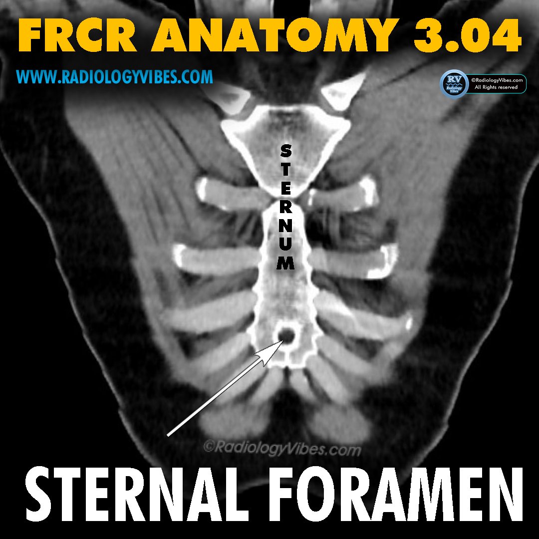 FRCR Anatomy 3.04: Sternal Foramen

#radres #FOAMrad #FRCR #radiology #anatomy #MedTwitter #radtwitter #FRCRanatomy
@Radiology_Vibes @anatomy4frcr @_the_SRT