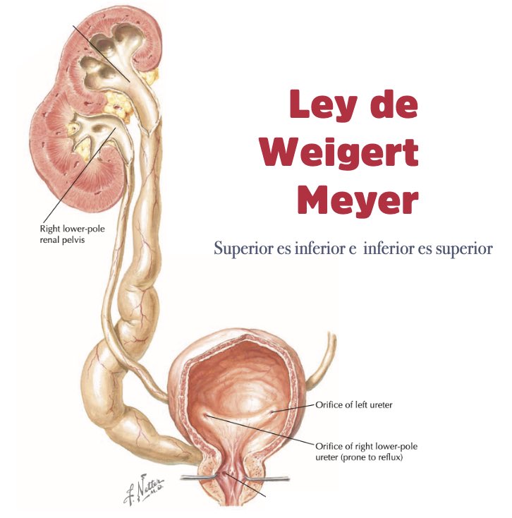 siupurol's tweet photo. En pacientes con doble sistema colector completo, la LEY DE 𝗪𝗘𝗜𝗚𝗘𝗥𝗧-𝗠𝗘𝗬𝗘𝗥 establece que el uréter que drena el polo superior del riñón se inserta medial y distal (inferior) al sitio de inserción del uréter que drena el polo inferior📚📝
#SoMe4PedSurg #UroSoMe #UroTip https://t.co/ajrVWsxW9p