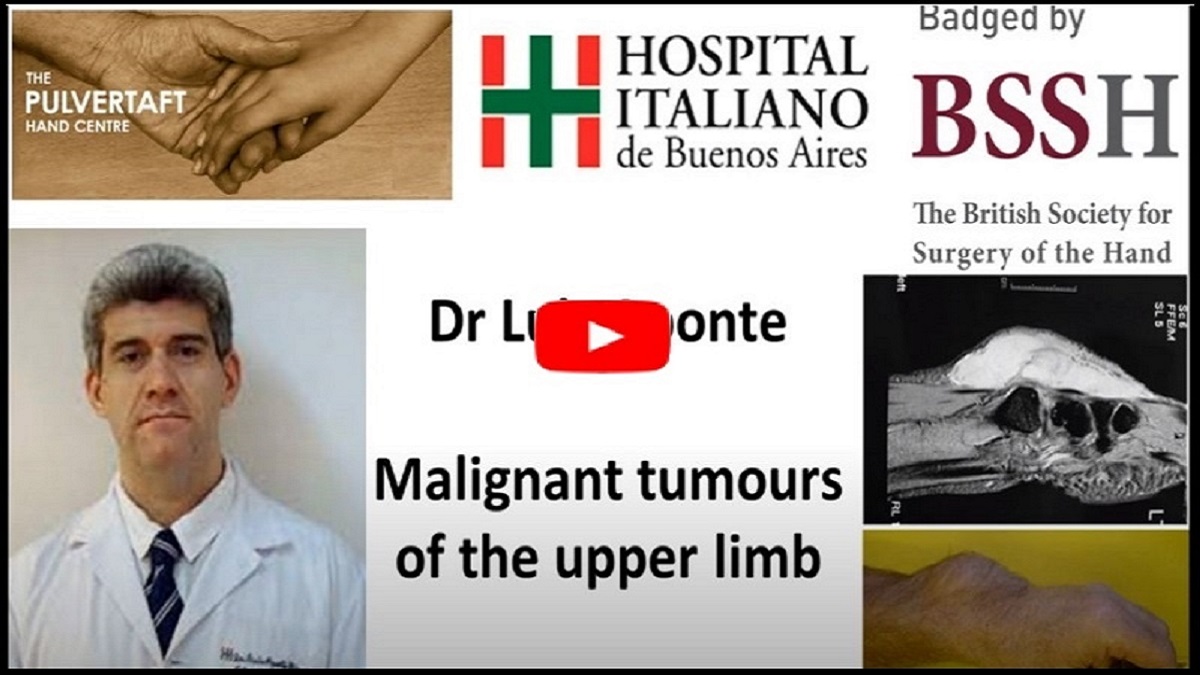 ipokrate's tweet photo. Management of malignant tumours of the upper limb by Dr Luis Aponte

Watch and learn today from the Pulvertaft Videos series on "The diagnosis, staging and treatment of malignant tumours of the upper limb..."

https://t.co/Lv3GG4mjyH

#ipokrate #conference #doctor https://t.co/jmVMvp3FWT