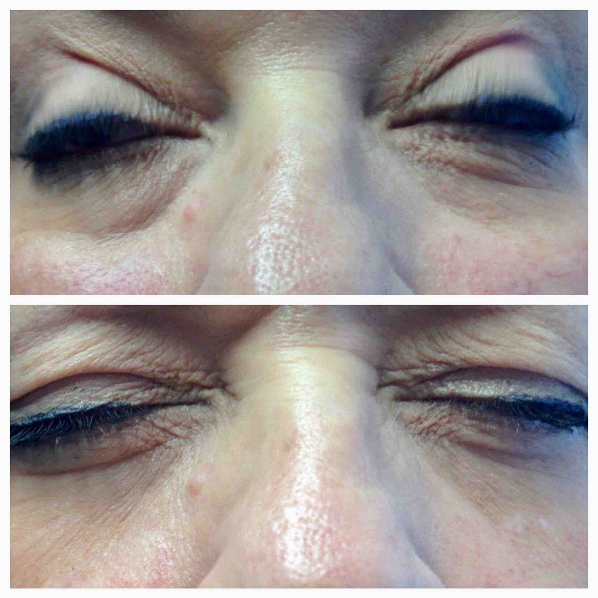 1 #syringe of #Belotero in the #teartroughs. Took years off her #face just by making her look more rested. Placed with a 25 gauge #cannula to minimize bruising and swelling. Results last at least a year. #drannetrussell #seibellamedspa 501-228-6237 🤩❤️😍 #LittleRock #physician