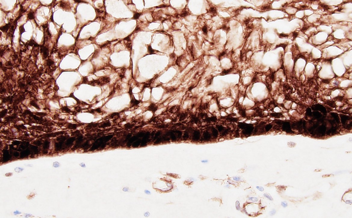Intracranial tumor located in the sellar region. Diagnosis? What is the mystery IHC and what does it suggest about the molecular underpinnings of this tumor? #neuropath 🧠🔬