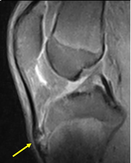CIC0826's tweet photo. An example of CT/MRI Osgood-Schlatter disease.
Pathology dealing with chronic fatigue on the apophysis of the tibial tuberosity, insertion site of the patellar tendon.
#knee #radMSK https://t.co/ekUC9Kk2fH