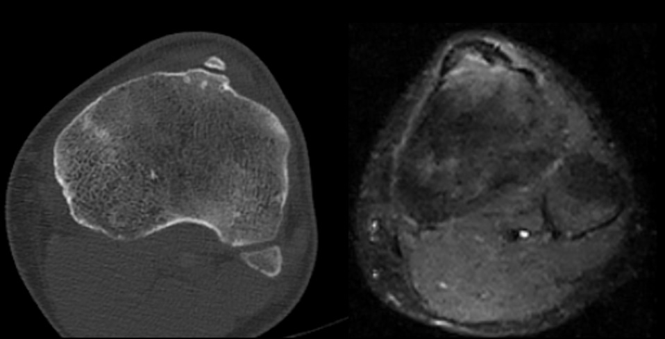 CIC0826's tweet photo. An example of CT/MRI Osgood-Schlatter disease.
Pathology dealing with chronic fatigue on the apophysis of the tibial tuberosity, insertion site of the patellar tendon.
#knee #radMSK https://t.co/ekUC9Kk2fH