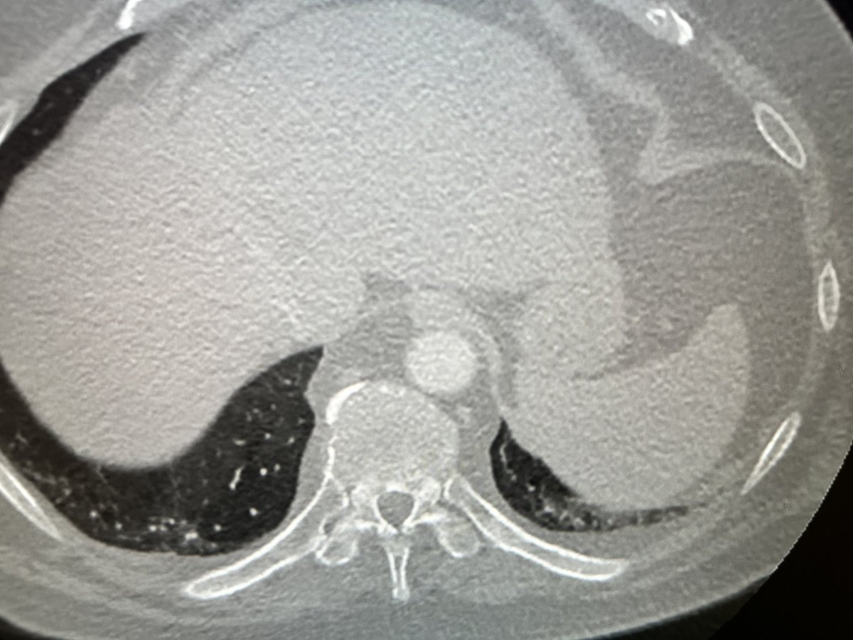 If most pulmonary embolism exams were cut off at this level, the national debt would be diminished by 37% in just two years by working up fewer incidental findings in the upper abdomen!😀