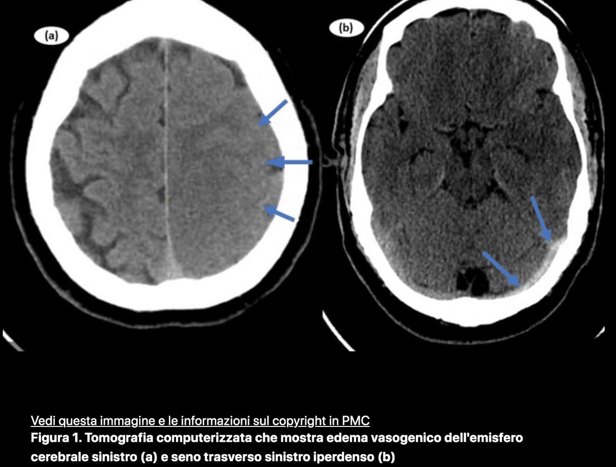 'Venografia TC che mostra un difetto di riempimento nel seno trasverso sinistro (frecce che mostrano l'assenza del seno trasverso sinistro)' 

Trombocitopenia immunitaria e trombosi del seno venoso cerebrale dopo la vaccinazione contro il COVID-19 pubmed.ncbi.nlm.nih.gov/36855477/