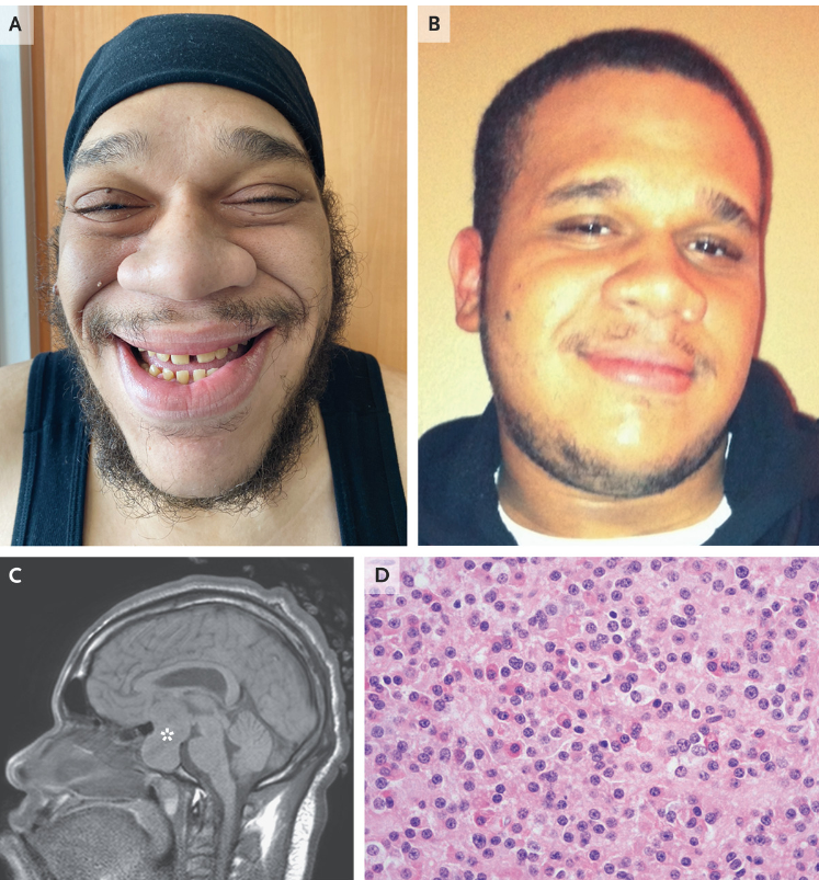 JSebastianPA's tweet photo. 🚨El diagnóstico de acromegalia puede demorar hasta 12 años desde el inicio de los síntomas 😯
A menudo, los pacientes no buscan atención médica porque los cambios en su apariencia son muy sutile👨‍⚕️🧑‍⚕️

📢 ¿Cuándo sospechar acromegalia? Aquí van 5 preguntas claves 🧵 https://t.co/wbVT5Kp4VH