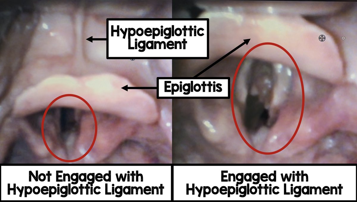 Airway Microskill: Engagement with Hypoepiglottic Ligament

Engagement of hypoepiglottic ligament is one of the key micro skills in obtaining the best view of the airway. Here is a short video on what this looks like.

youtube.com/watch?v=04PEeJ…

#FOAMed #FOAMcc #intubation #airway