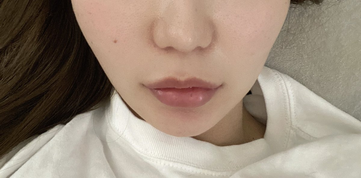 hs_vnk's tweet photo. 鼻フルやって半年経ったから、
多分もうdt終わり🧸
顔の脂肪吸引4部位は
3ヶ月経過しました💉（まだ若干の拘縮あり
あとえくぼ作ってもらった〜！
5分くらいで終わる簡単な手術で
抜糸もない���
笑った時にだけ出てくるようになるらしい🤍
全て、ヒット整形外科さんです🧡 https://t.co/jt0j1kaAYv