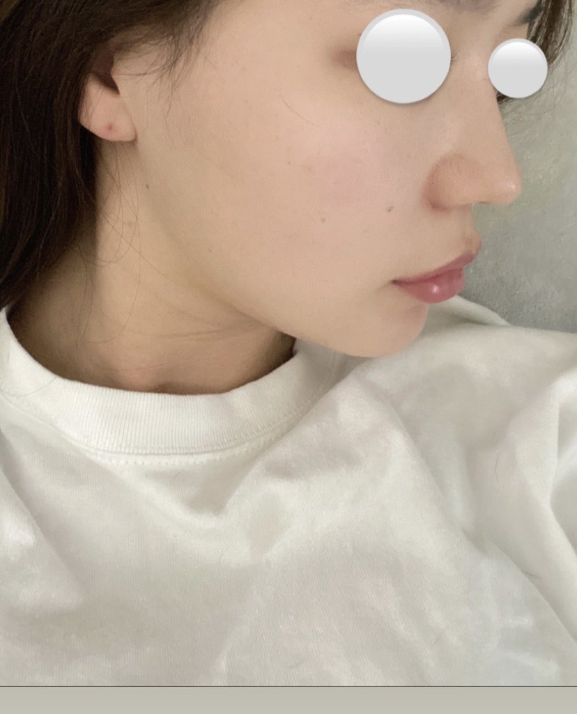 hs_vnk's tweet photo. 鼻フルやって半年経ったから、
多分もうdt終わり🧸
顔の脂肪吸引4部位は
3ヶ月経過しました💉（まだ若干の拘縮あり
あとえくぼ作ってもらった〜！
5分くらいで終わる簡単な手術で
抜糸もない���
笑った時にだけ出てくるようになるらしい🤍
全て、ヒット整形外科さんです🧡 https://t.co/jt0j1kaAYv