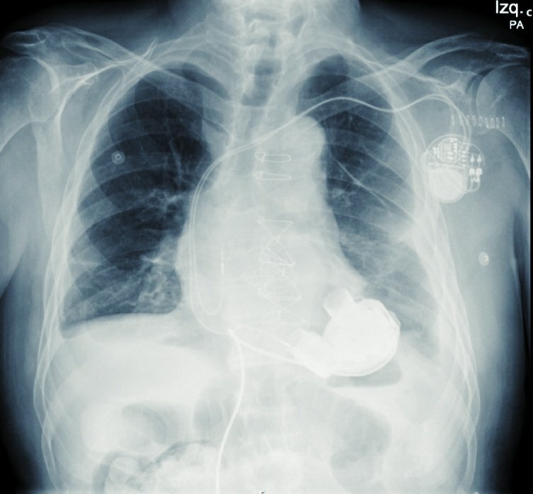 Successful TAVI implantation in a continuous aortic regurgitation post-HeartMate3. #CardioTwitter @secardiologia @imagen_sec @ICardiacaSEC @AgudosSEC @JovenesSec @ResisCardioVigo #Cardiology