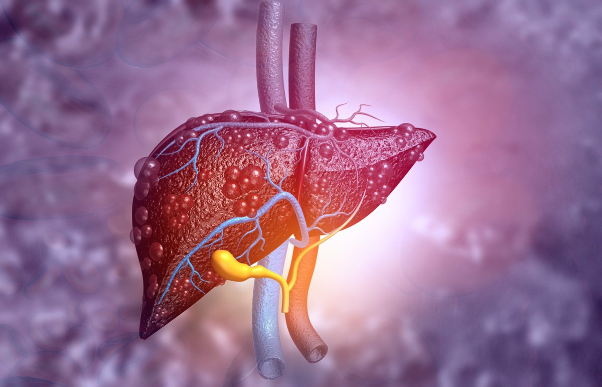 CU Department of Medicine (@cudeptmedicine) on Twitter photo Tune in to Dr. Avash Kalra’s talk on Malnutrition & Frailty in Chronic Liver Disease at #RMH2023! Register (FREE) to learn about the hottest topics in Hepatology! bit.ly/RMH2023 #hepatology #FattyLiver #liver #transplant #NASH <a href="/AGA_Gastro/">Gastroenterology</a> <a href="/ASGEendoscopy/">ASGE GI Endoscopy</a> <a href="/GILiverImmunity/">GI and Liver Innate Immunity</a> Tune in to Dr. Avash Kalra’s talk on Malnutrition & Frailty in Chronic Liver Disease at #RMH2023! Register (FREE) to learn about the hottest topics in Hepatology! bit.ly/RMH2023 #hepatology #FattyLiver #liver #transplant #NASH <a href="/AGA_Gastro/">Gastroenterology</a> <a href="/ASGEendoscopy/">ASGE GI Endoscopy</a> <a href="/GILiverImmunity/">GI and Liver Innate Immunity</a>