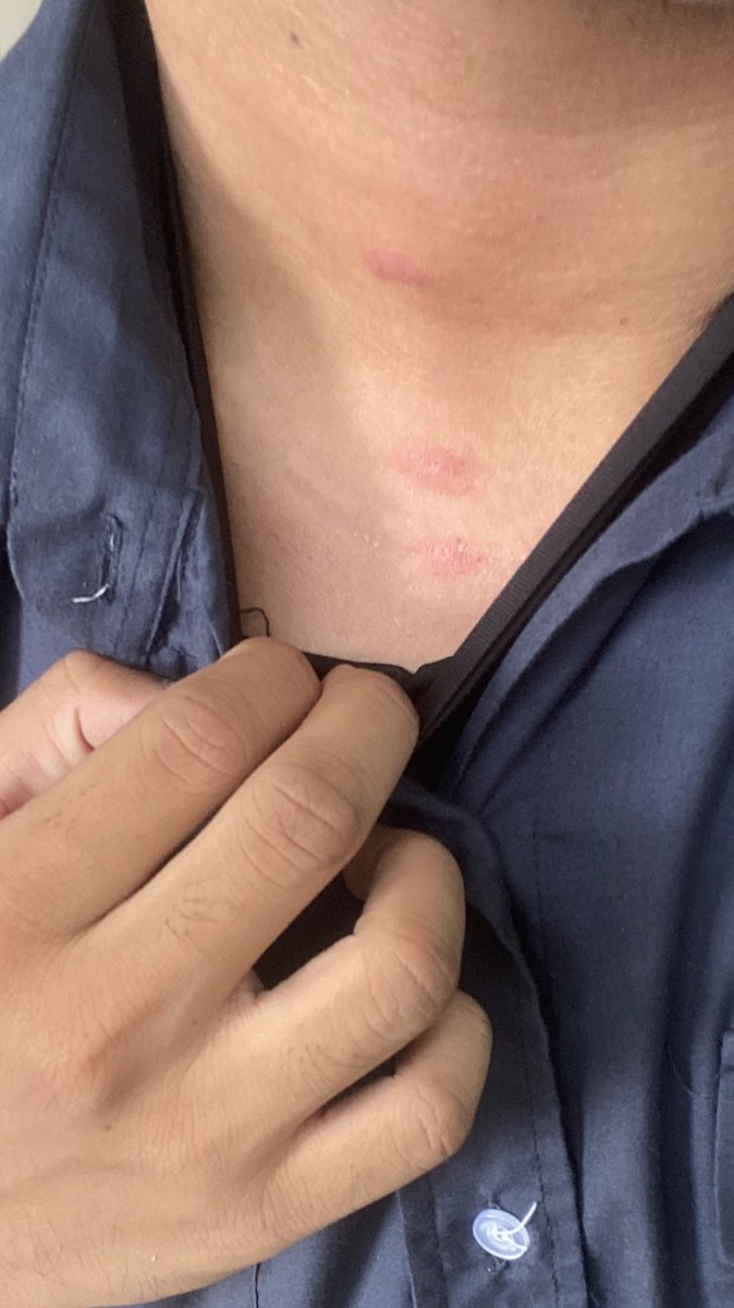 seketulakasah's tweet photo. Samalah.... Sampaikan mak aku tanya kenapa leher tu 😭 https://t.co/jAAYakN8pT