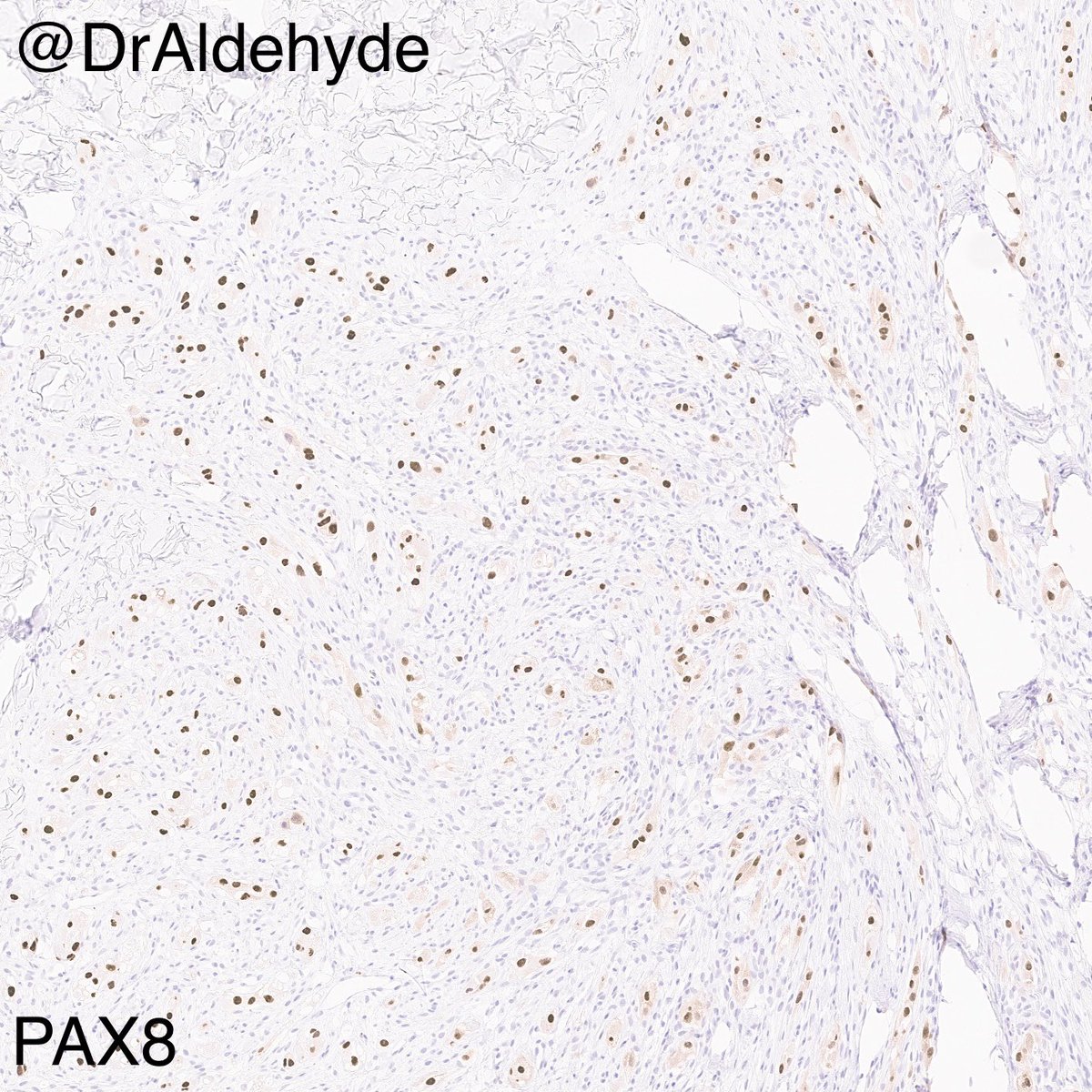 Wednesday #dermpath special. 😆🔬

This low power view reminds me of a volcanic eruption. 🌋

Cutaneous metastasis of renal cell carcinoma

#pathology #GUpath