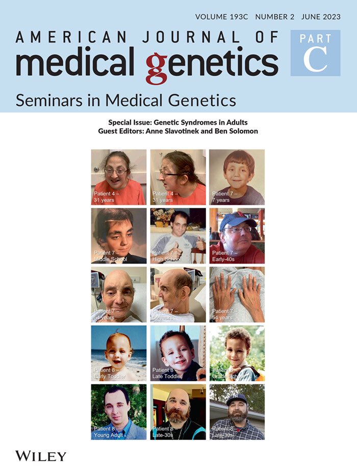 Congrats to the amazing <a href="/MommasaurusJess/">Jessica Priestley, MD PhD</a>, who took the last few months to produce an adorable infant AND this fantastic paper, the first study of #Kabuki syndrome in adulthood. We describe an unreported premature #aging phenotype in this #genetic syndrome: dx.doi.org/10.1002/ajmg.c…