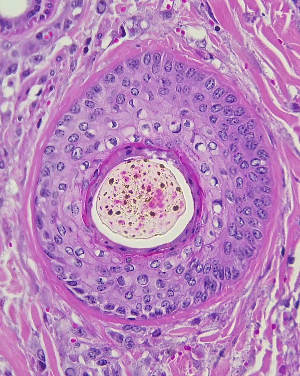 olkazuraw's tweet photo. This is a cross-section of hair.

After reading Dr. Bui's book "The Healing Art of Pathology" I am 

inspired again to take more pictures of the beautiful structures that 

#pathart 
#digitlart 
#microscopicphotography 
#microphoto 
#Ilovepathology 
#microart https://t.co/pomMMx79em