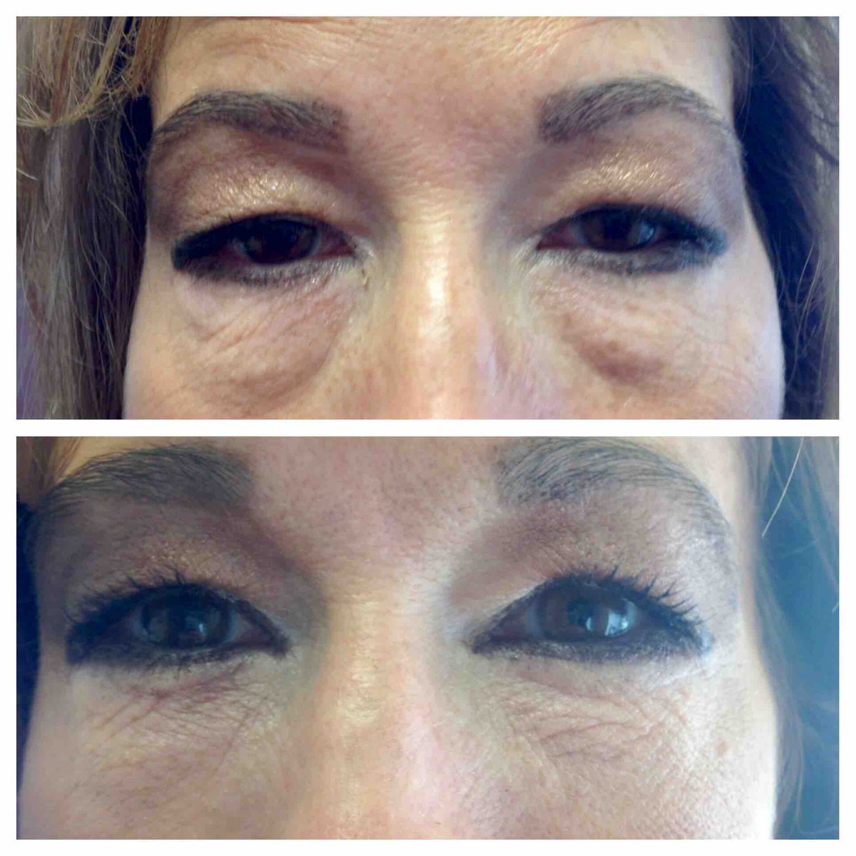 One #syringe of #Belotero in the #teartroughs. Placed with a 25 gauge #cannula to minimize bruising and swelling. Not everyone is a candidate. People who have fat pads that have herniated upward are best served with a #blepharoplasty. #drannetrussell #seibellamedspa 501-228-6237