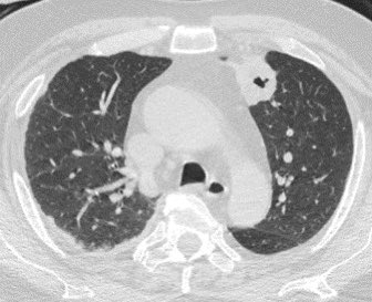 What is the most likely diagnosis in this 50 y/o M w/ hematuria and decreased urine output? 🤔 

#Neurology #Neurosurgery #ent #MedTwitter #meded #radres #futureradres @ASHNRSociety