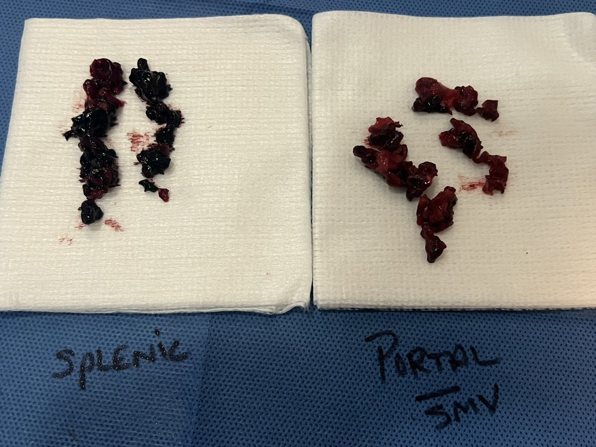 Mixed chronicity portomesenteric thrombosis, transjugular transhepatic <a href="/InariMedical/">Inari, now part of Stryker</a> FlowTriever T16 thrombectomy, excellent technical/clinical results! FT2 essential to engage more chronic components - interested to hear opinions thrombectomy vs thrombolysis in this space …