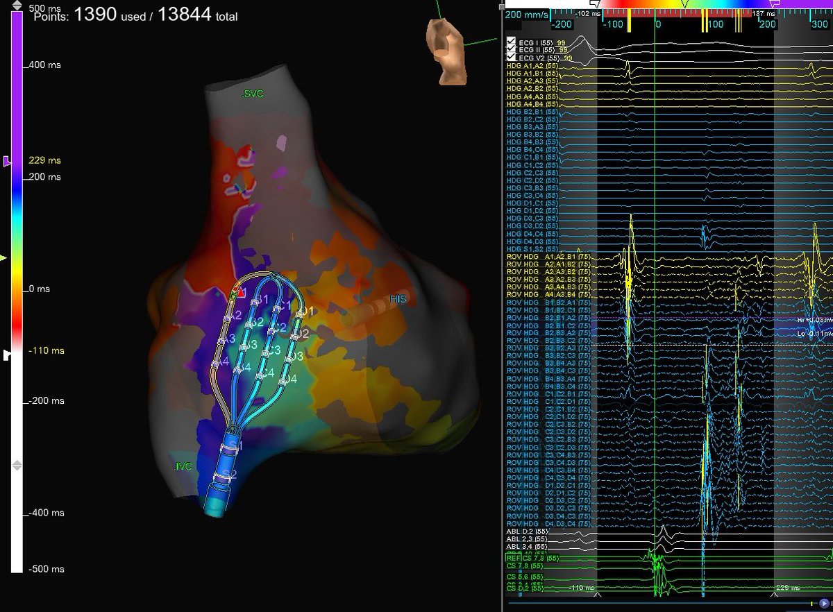 Love these signals from the #HDGrid! Right atrial flutter circuit using an atriotomy scar. You can see almost the entire cycle length in this one beat! Mapped and ablated by @MonicaYLo 
#MapMoreBurnLess #AbbottProud #EnsiteX