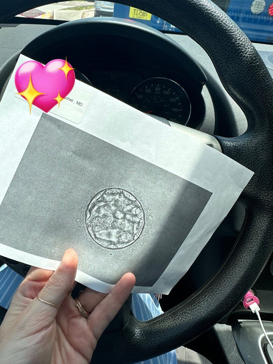 AshBuggin's tweet image. Look at this perfect BB girl. She has my eyes #embryo #ivf #embryotransfer