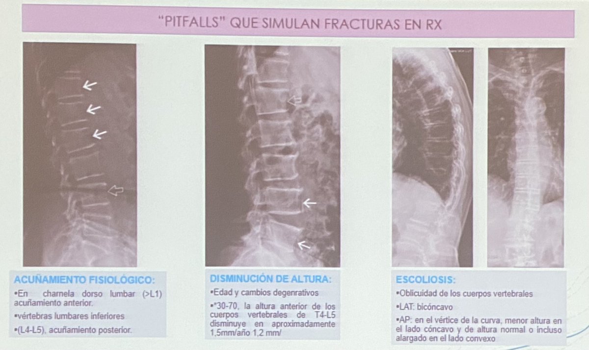 La Dra. Rodriguez Álvarez nos presenta algunos “pitfalls” capaces de simular una fractura vertebral 🦴🩻🏹