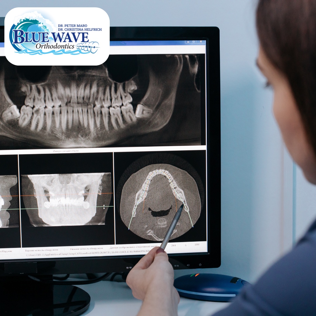 At Blue Wave Orthodontics, we use sophisticated technology. Call our Darien office at (203) 202-7610 or our Rye office at (914) 967-2277.

#bluewaveorthodontics #ctorthodontics #invisalign #braces #darienct #dentalcare #smile #smiletransformation #confidentsmiles #bracesjourney