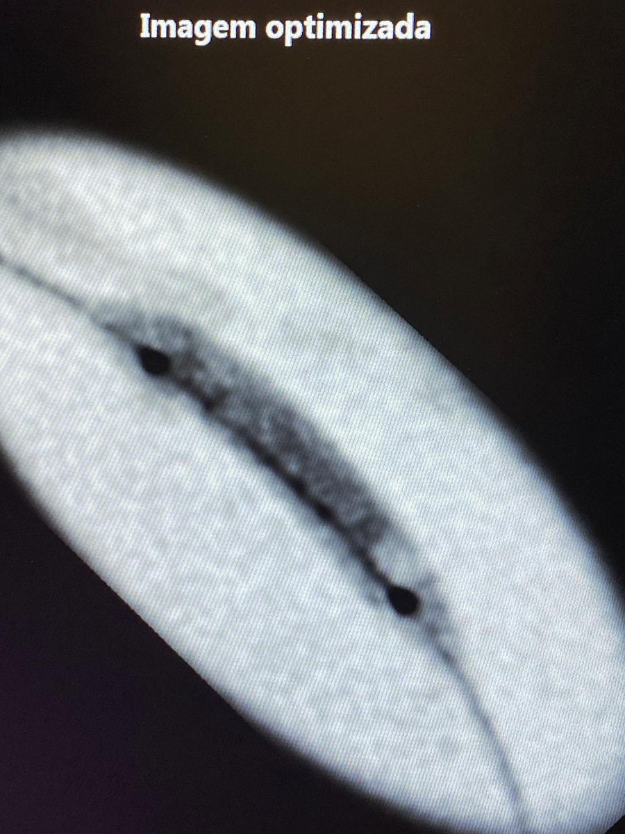 Very interesting live case during the 38th edition of D@CL by <a href="/APIC_pt/">APIC</a>. Heavily Ca++ proximal LAD treated with #ShockwaveC2plus with great results! A big thank you to Dr. R. Santos, Dr. <a href="/jbrumsilveira/">joao brum silveira</a> and the hospital Setubal staff for their support  
ISI bit.ly/3iEq7fC