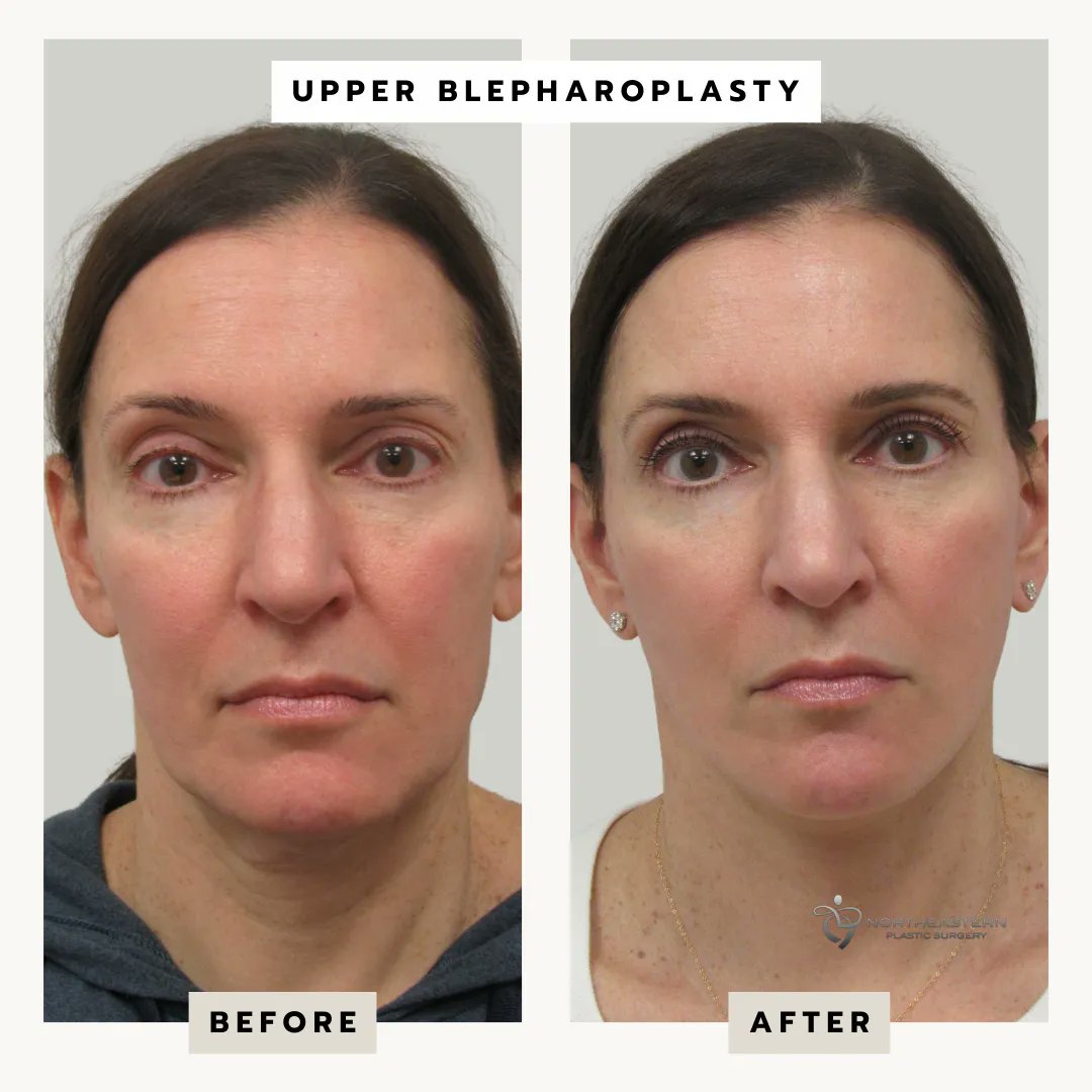 An Upper Blepharoplasty produced these results!

Do you notice the difference in the before and after? Comment below what you think!