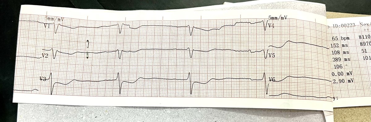 FaranAshrafCh's tweet image. 55/M presented with vomiting, dizziness &amp;amp; chest pain.
ACS given, ecg ordered, 
What is your diagnosis?
#cardiobot #Cardiology #ecg @PMcardioBot @EcgsOnly @EcgOxford #medicine #emergencymedicine