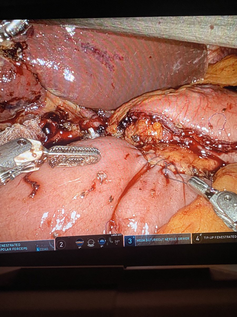 Pancreático-yeyunostomía en DPC mínimamente invasiva🤖: 
1) Barbada posterior y anterior
2) Ductomucosa 🪡 PDS: posterior continua/anterior puntos sultos
Cómo lo haceis❓@VMolina_82 <a href="/fpa_que/">FPardo</a> <a href="/santiazagra/">Juan Santiago Azagra</a> <a href="/HpbMar/">HPB unit Hospital del Mar</a> <a href="/aechbp/">AecHBP</a> <a href="/SeclaEndosurg/">SECLA</a> <a href="/scmi_itec/">aec_cmi</a> <a href="/hpb_so/">SoMe4HPB</a>