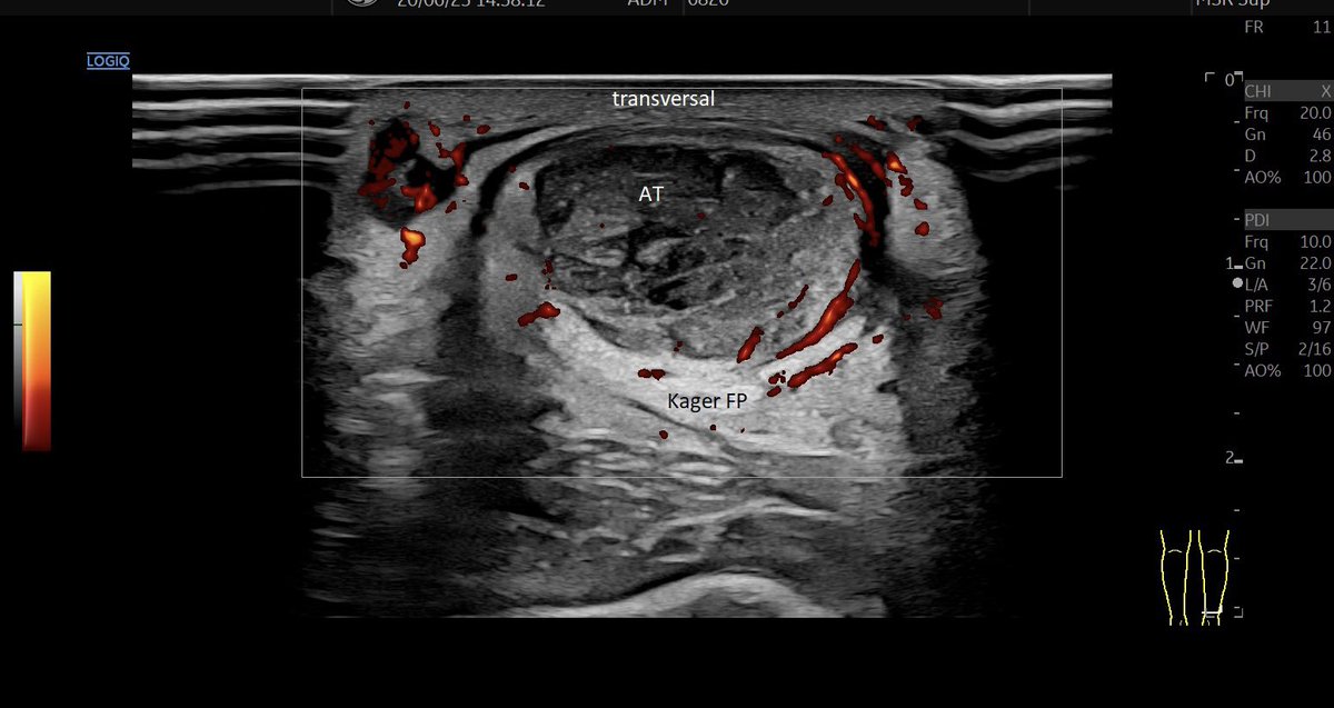 #tendinopathy of the #achillestendon with #neovascularisation in B-Mode #mskus #pocus #pocushub #GElogiqE10r3 #bmode