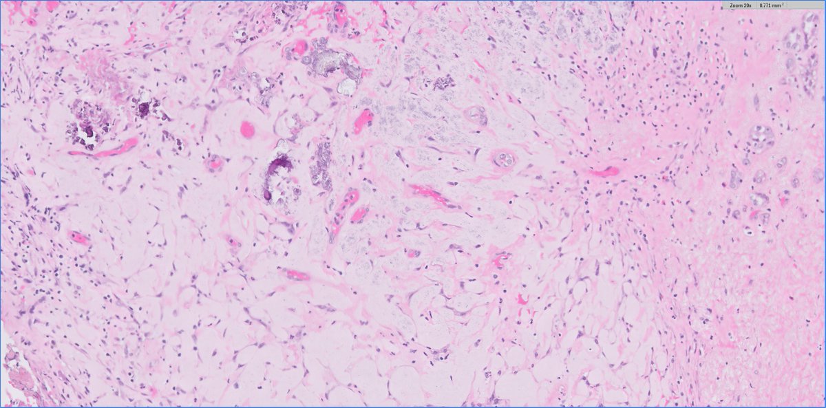 #GUpath🧩time!

#pathtwitter #pathresidents:
what's going here in this section from neoadjuvant radical cystectomy for pT2 urothelial ca
🤨❓🔬