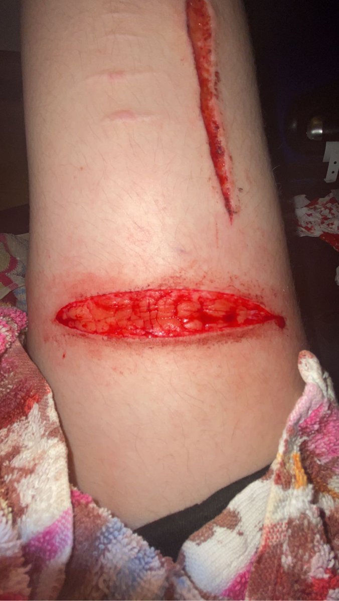 cutsnwounds's tweet photo. tw || sh

start vs finish https://t.co/bxdGWG2sOl