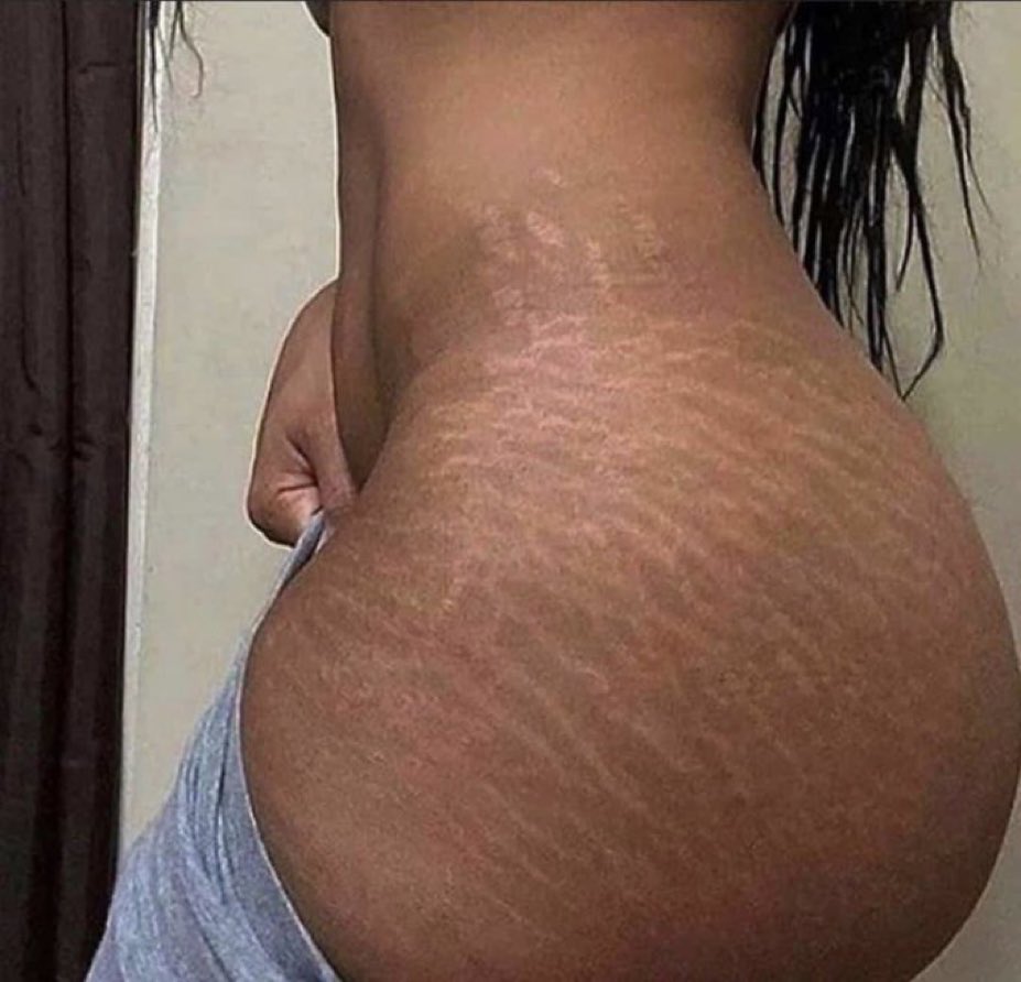 Let’s not lie to ourselves, stretch marks are unattractive.