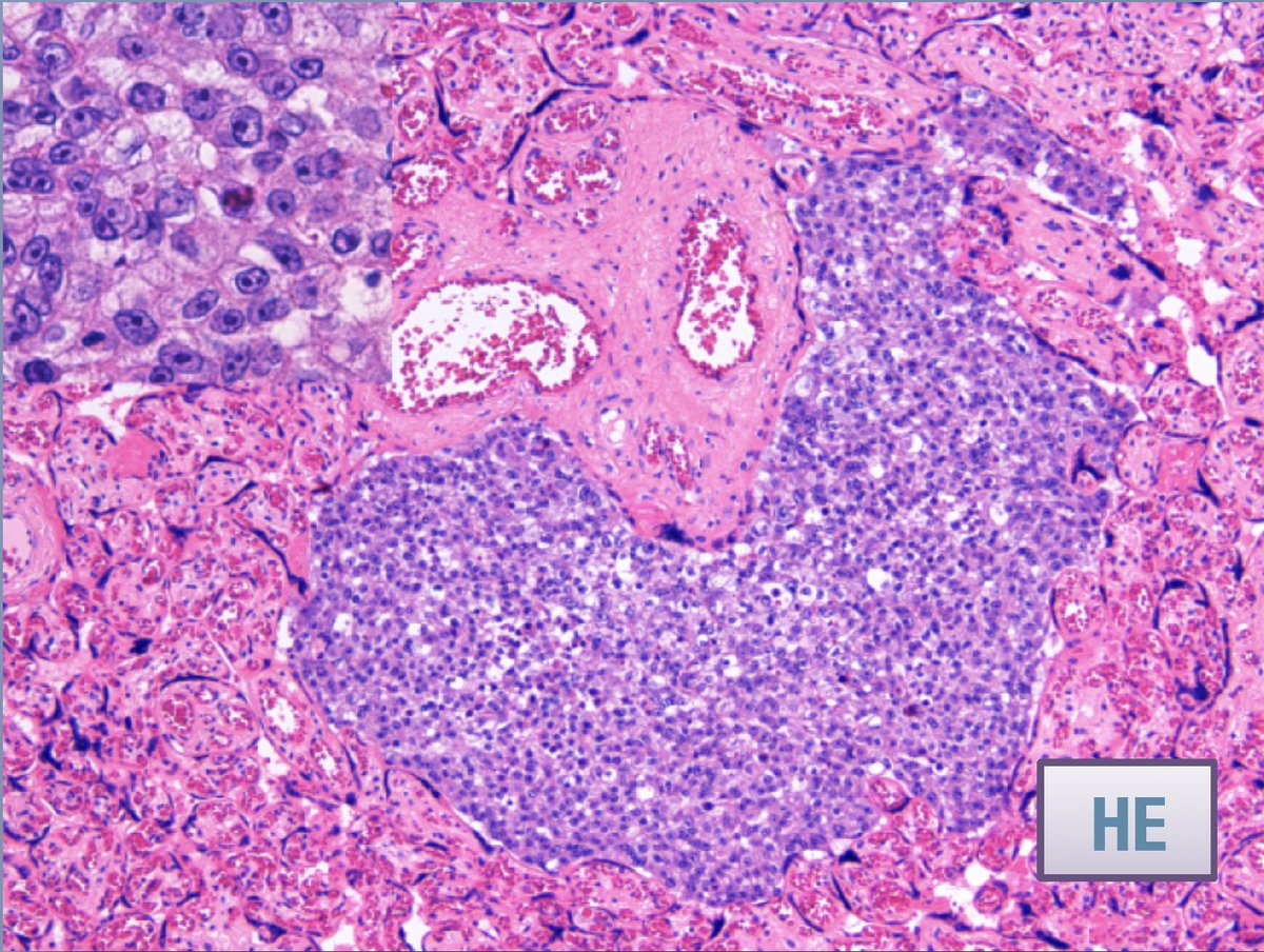Current Problems in Cancer & CPC: Case Reports tweet media
