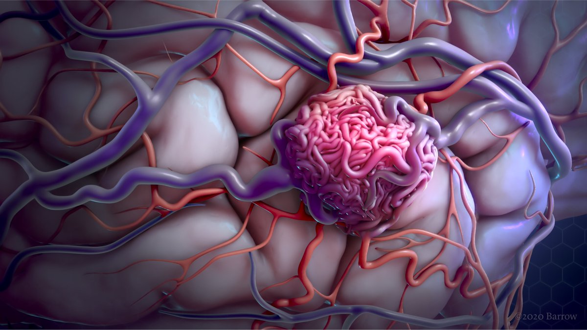 BarrowNeurological (@barrowneuro) on Twitter photo It's #HHTGlobalAwarenessDay & #HHTAwarenessMonth. People with HHT may develop multiple #AVMs, which can rupture & bleed. Our HHT Program allows patients to see an integrated team of specialists & is designated as a Center of Excellence by <a href="/curehht/">Cure HHT</a>: BarrowNeuro.org/HHT It's #HHTGlobalAwarenessDay & #HHTAwarenessMonth. People with HHT may develop multiple #AVMs, which can rupture & bleed. Our HHT Program allows patients to see an integrated team of specialists & is designated as a Center of Excellence by <a href="/curehht/">Cure HHT</a>: BarrowNeuro.org/HHT