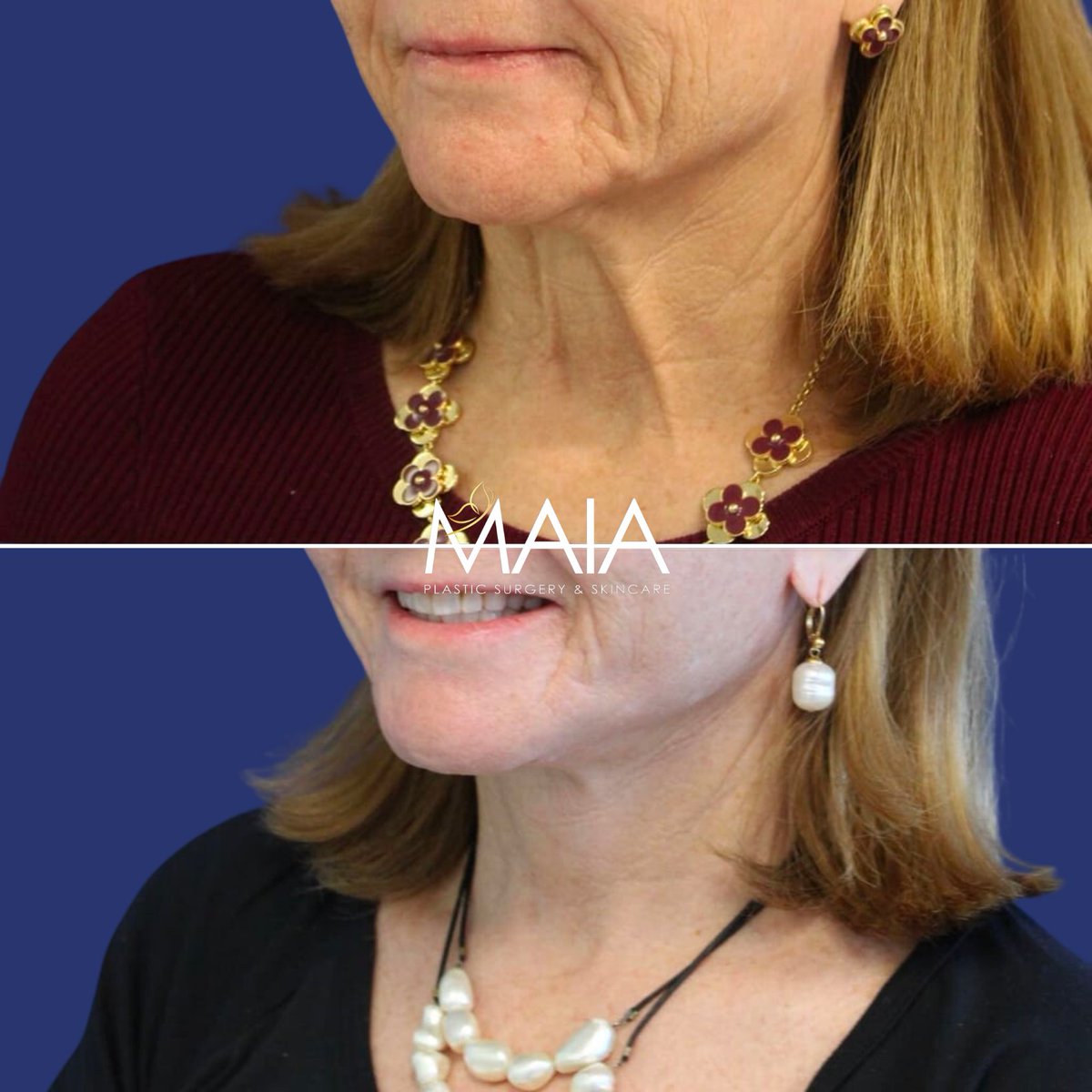 64 year-old patient before after #facelift, #necklift, lower and upper #blepharoplasty, #canthopexy & #CO2laser