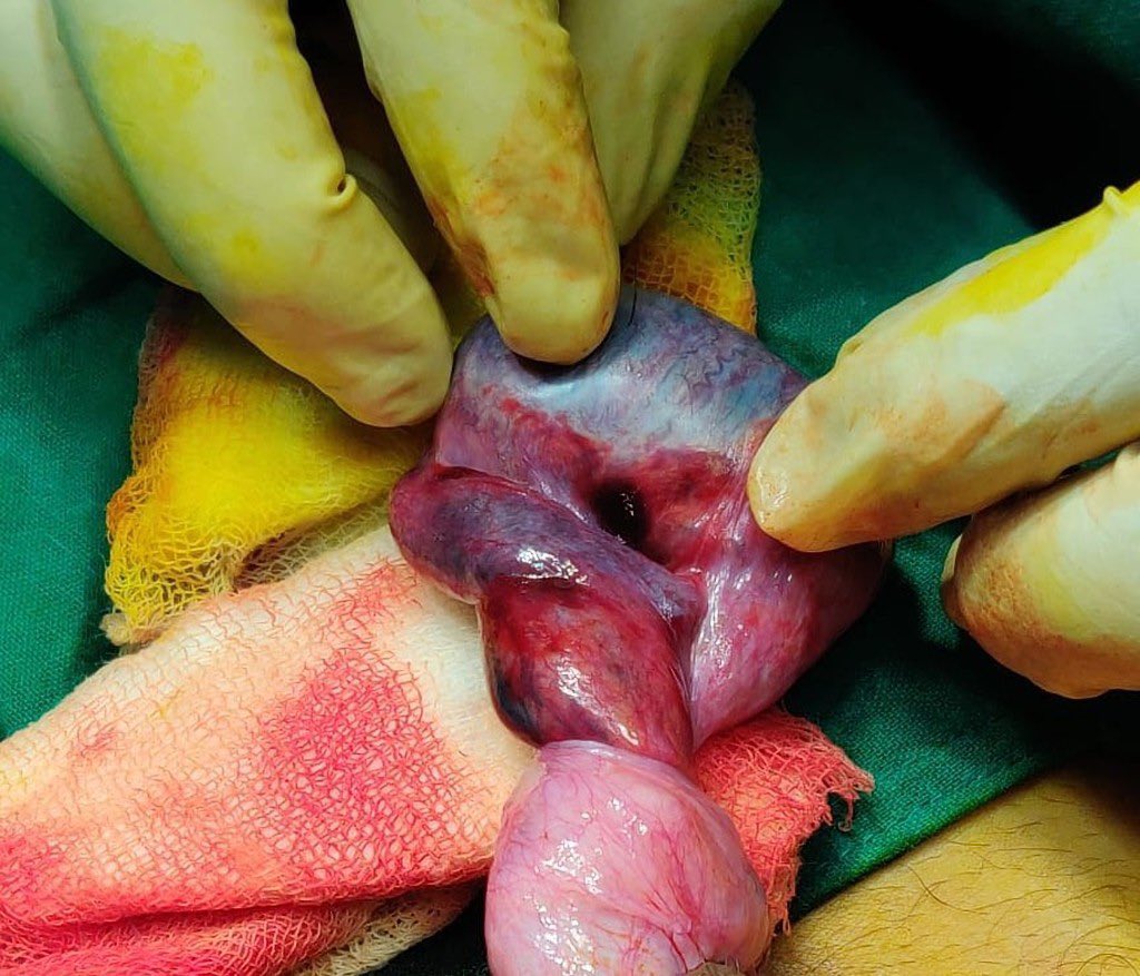 _elvis_simons's tweet image. Testicular torsion is a severe condition that can happen to every man.

It occurs when the testicle rotates, twisting and obstructing the spermatic cord that supplies blood to the testicles.

This can make one lose one or both testicles if not treated on time.