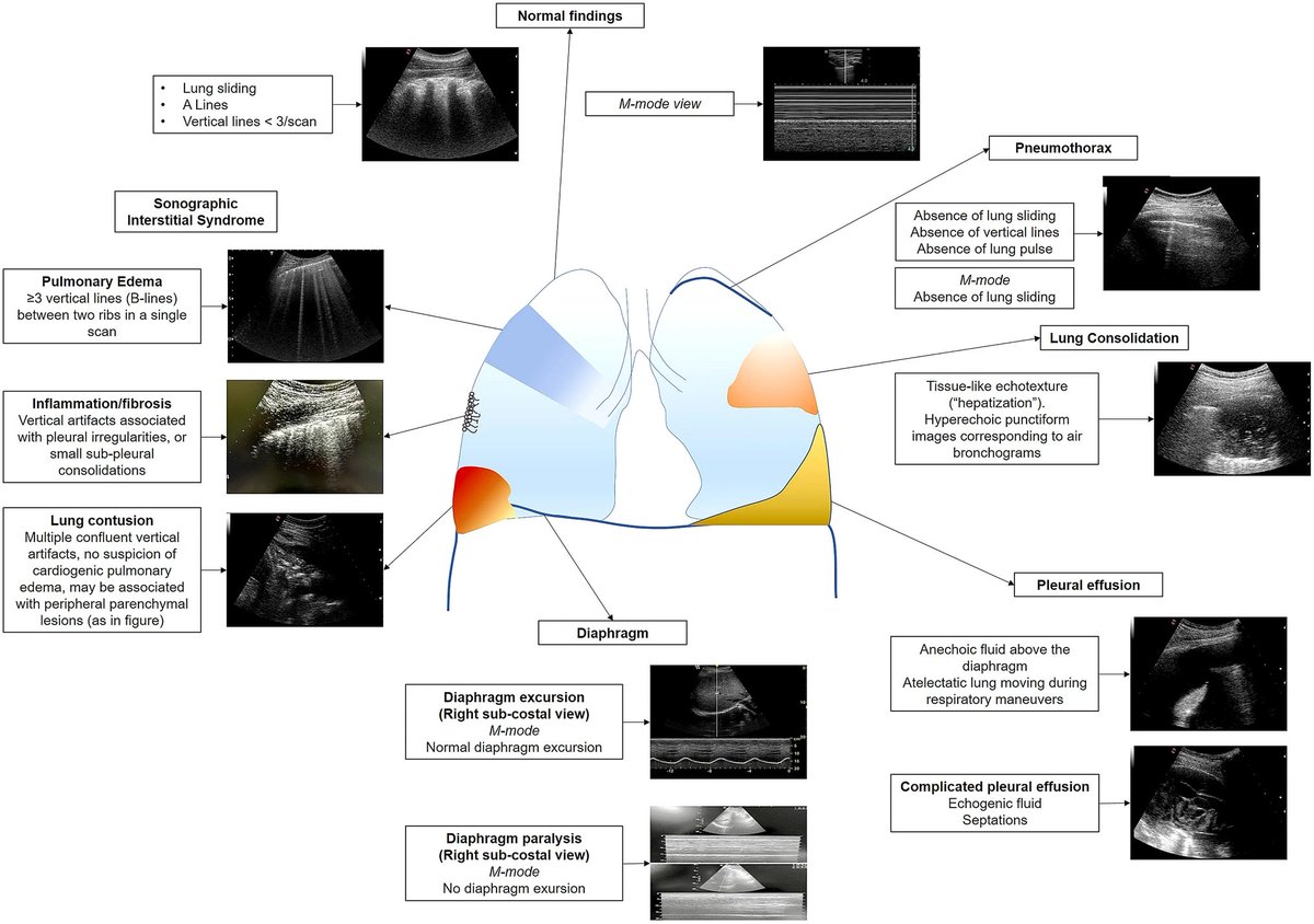 NephroP's tweet image. Acute dyspnea in the emergency department: a clinical review🔗link.springer.com/article/10.100…
#POCUS #IMPOCUS #FOAMcc #MedEd