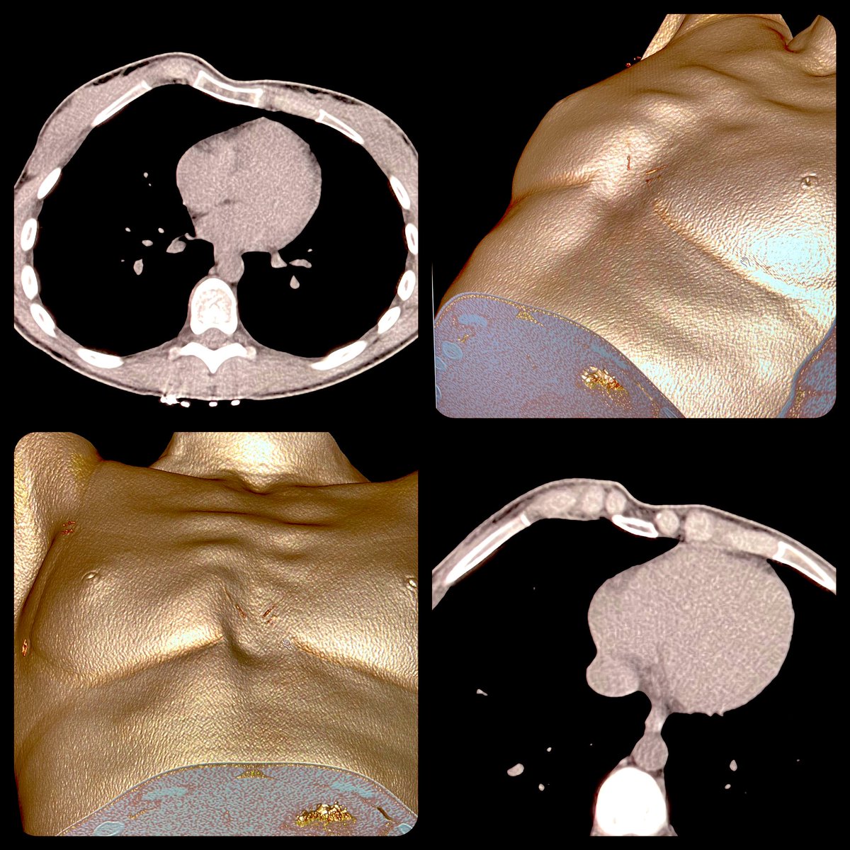 Kamal Tarabine (@kamaltarabine) on Twitter photo Case of Pectus Arcuatum (aka Pouter pigeon chest)
=> Asymmetrical protrusion of the chest at the upper part of the sternum, notably at the manubriosternal junction and the 2nd to 5th ribs cartilages #radiology <a href="/BrighamRad/">Brigham and Women's Radiology</a> Case of Pectus Arcuatum (aka Pouter pigeon chest)
=> Asymmetrical protrusion of the chest at the upper part of the sternum, notably at the manubriosternal junction and the 2nd to 5th ribs cartilages #radiology <a href="/BrighamRad/">Brigham and Women's Radiology</a>