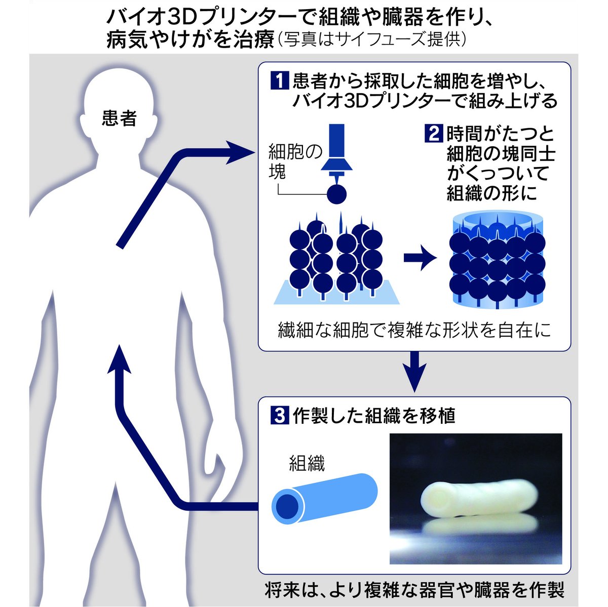 「バイオ3Dプリンター」で指の神経を治療。京都大学が成功しました。
nikkei.com/article/DGXZQO…

患者から採取した細胞を培養し、3Dプリンターで積み上げ。組織を移植して神経を再生します。様々な治療に応用できる可能性があります。